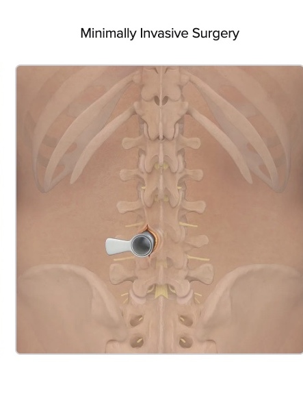 Minimally invasive spine surgery approach with tubular retractor