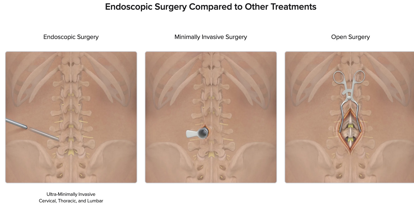 Comparison of endoscopic, minimally invasive, and open spine surgery approaches showing relative incision sizes