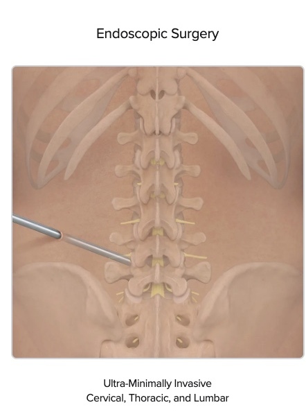 Endoscopic spine surgery approach showing minimal incision