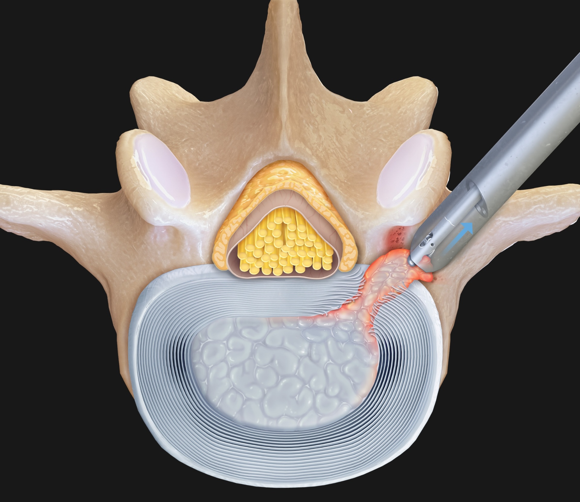 Axial cross-section showing endoscopic transforaminal approach to a herniated lumbar disc