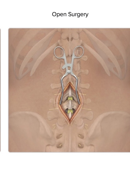 Open spine surgery approach with full incision and retractors