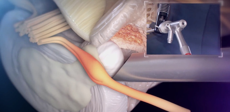 Close-up illustration of endoscopic instrument decompressing a spinal nerve root