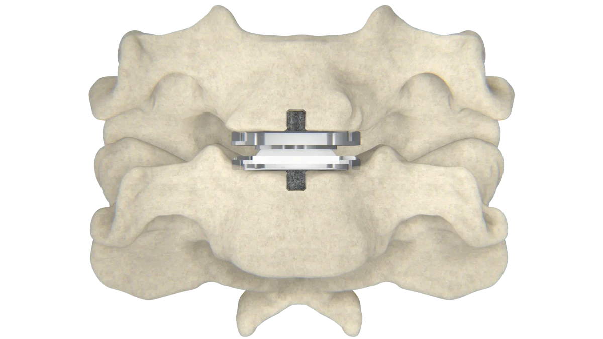 Artificial cervical disc implanted between two vertebrae