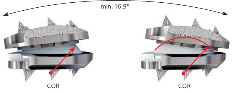 Diagram showing the range of motion preserved by an artificial cervical disc