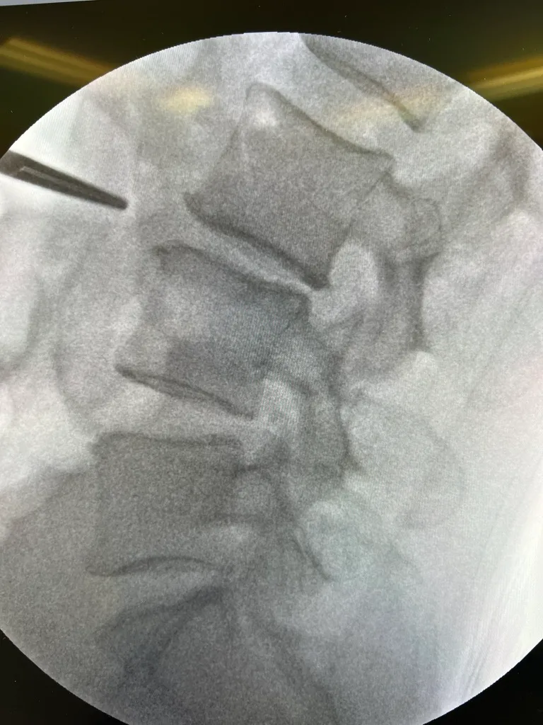 Intraoperative fluoroscopy showing instrument positioning at the disc space