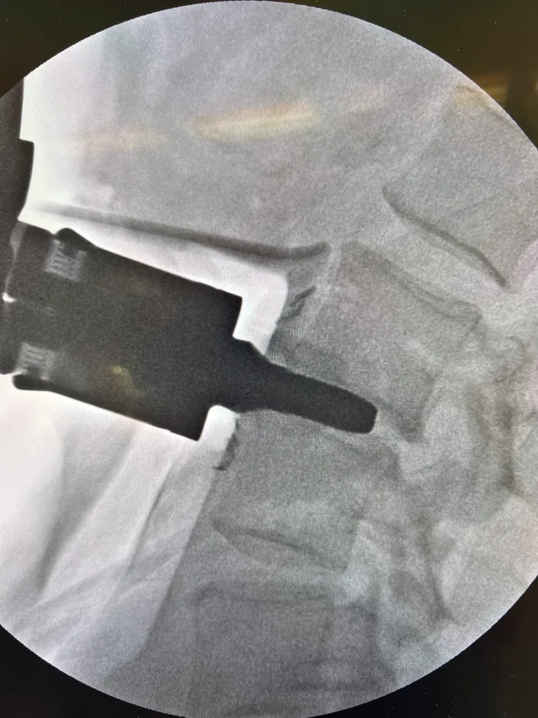 Intraoperative fluoroscopy showing the disc space prepared for implant placement