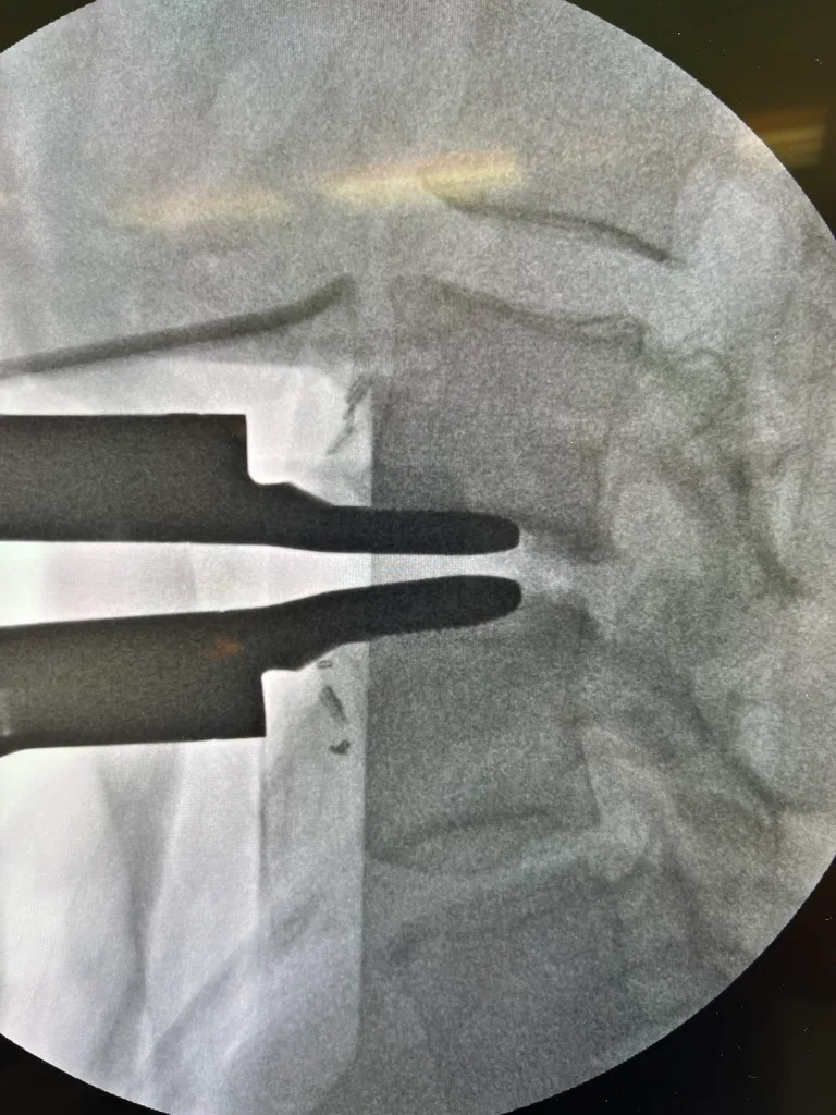 Intraoperative fluoroscopy showing instruments seated at the treated level