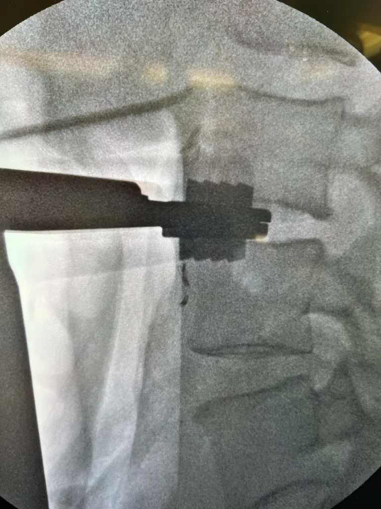 Intraoperative fluoroscopy confirming implant position at the treated level