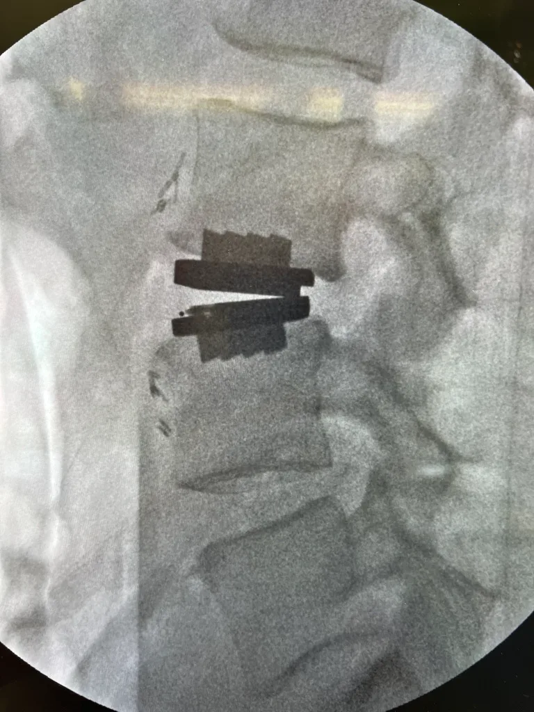 Intraoperative lateral fluoroscopy showing the artificial disc implant in final position