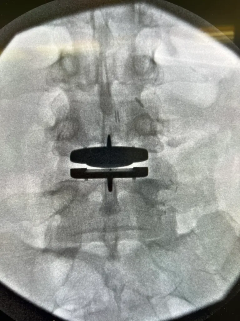 Intraoperative AP fluoroscopy showing midline placement of a lumbar disc replacement
