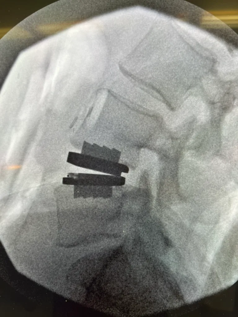 Intraoperative lateral fluoroscopy showing a lumbar disc replacement implant in position